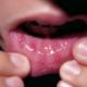 Стоматит во рту у взрослых: бывает ли, как и чем лечат